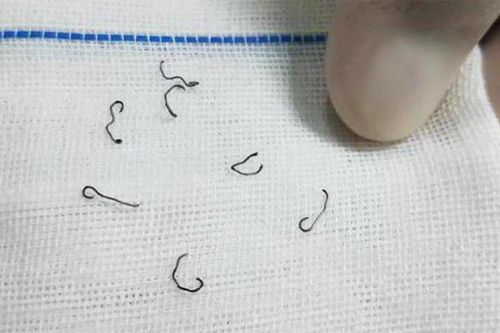 Sau cắt trĩ, người phụ nữ phải nhập viện nhổ đinh 8 lần và bị suy thận