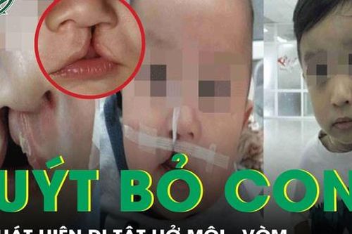 Suýt không được chào đời vì dị tật hở môi, bé trai trở thành niềm tự hào của gia đình