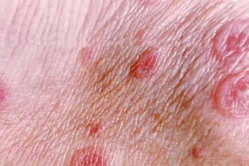 Câu hỏi thường gặp liên quan đến bệnh hồng ban đa dạng