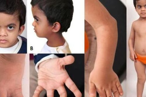 Câu hỏi thường gặp liên quan đến loạn sản sụn xương