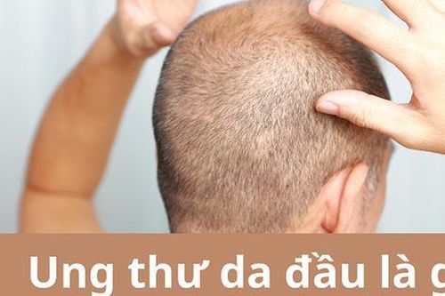 Ung thư da đầu: Nguyên nhân, triệu chứng, cách điều trị và phòng bệnh