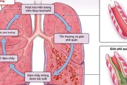 Giãn phế quản: Nguyên nhân, biểu hiện, cách điều trị và phòng bệnh