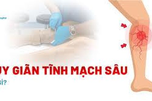 Bị suy giãn tĩnh mạch sâu nhưng phải đi làm liên tục, nên chữa thế nào?