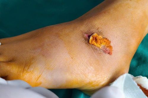 Nguy kịch vì một vết thương nhỏ ở chân