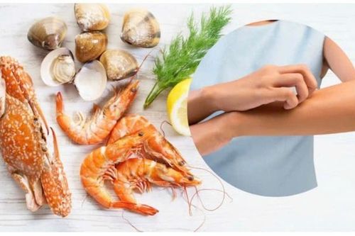 Đi du lịch biển, cần chú ý 6 loại hải sản dễ gây dị ứng nhất