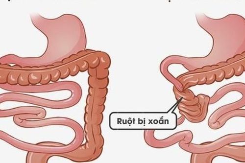 Đau bụng cảnh giác với xoắn ruột cần nhập viện khẩn cấp