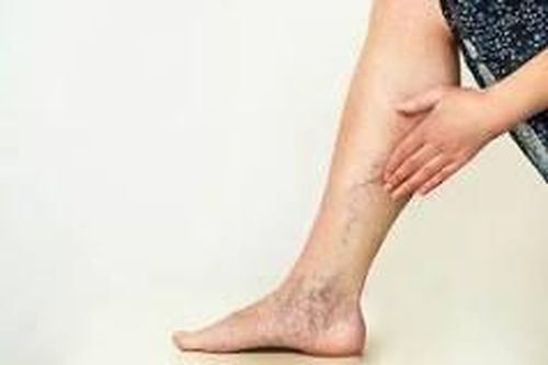 Suy giãn tĩnh mạch chân có nên đi bộ không?