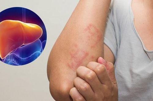 Mùa hè nắng nóng, khi nào nên thải độc gan, đây là 3 nhóm người cần cảnh giác
