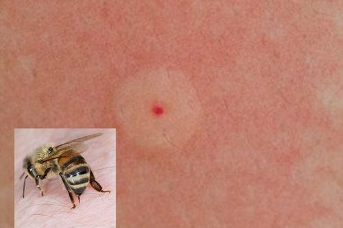 Bé 3 tuổi bị sốc phản vệ độ 3, suy hô hấp do ong đốt