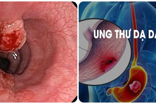 7 dấu hiệu ung thư dạ dày thường gặp không nên bỏ qua