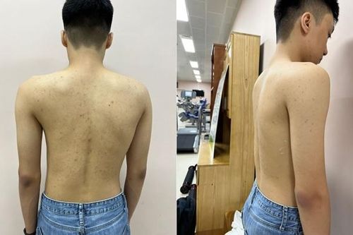 Tin vui cho trẻ mắc bệnh lý gù, vẹo cột sống