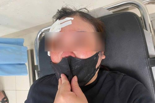 Hà Nội: Một phụ nữ tố bị người đi ô tô dùng dùi cui đập vào đầu vì không tránh đường