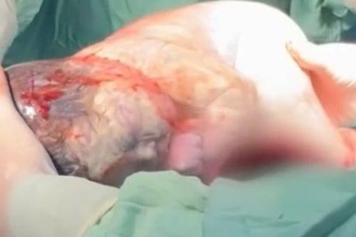 Bé gái nặng hơn 3 kg được sinh ra trong bọc ối còn nguyên vẹn