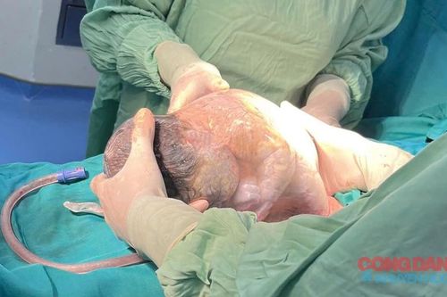 Bé gái chào đời nguyên vẹn trong túi ối hiếm gặp ở Nghệ An