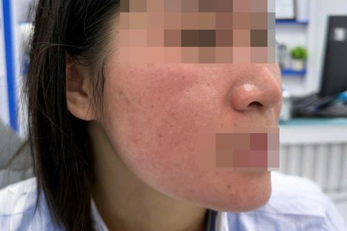 Bỏng da mặt vì dùng chanh tươi trị mụn