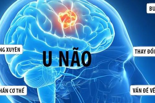 Làm thế nào để biết mình bị u não?