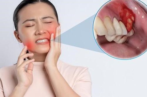Nhiễm trùng Implant nguyên nhân do đâu? Dấu hiệu và cách khắc phục