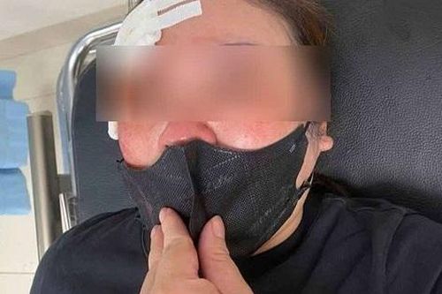 Xin tránh đường không được, người đàn ông đi ô tô dùng dùi cui vụt vào đầu một phụ nữ
