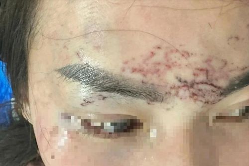 Khởi tố vụ đánh ghen xăm lên mặt, tạt axit gây xôn xao ở Cà Mau