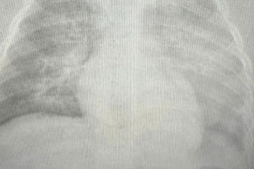 Bé gái 8 tuổi sốc nhiễm trùng, suy gan, phổi trắng xóa sau 6 giờ nhập viện vì biến chứng sởi