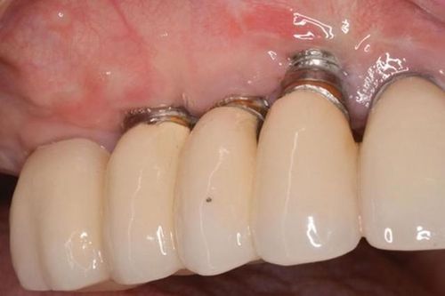 Implant bị đào thải do đâu? Cách khắc phục?
