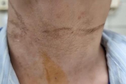 Bé trai nhập viện khẩn do nghịch dây rút quần, khuyến cáo những điều bố mẹ nên biết để bảo vệ con trong dịp nghỉ hè