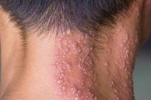 Mắc zona thần kinh có cần kiêng gì không?