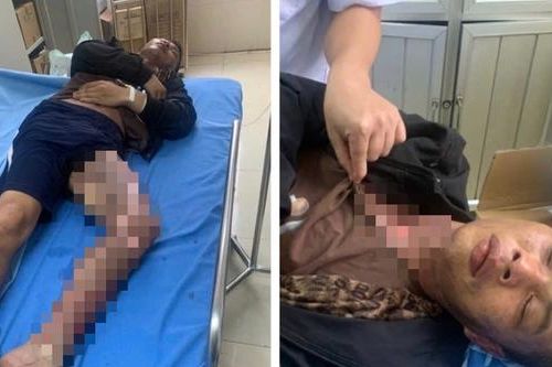 Leo trạm biến áp cắt trộm dây điện, hai người bị điện giật bỏng nặng