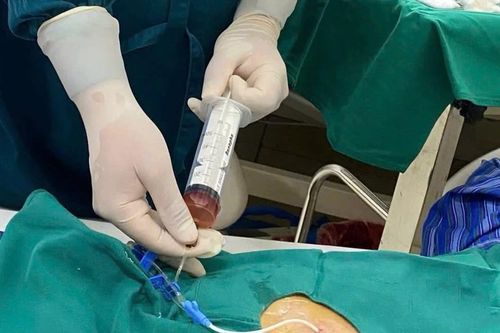 Cứu sống cụ ông bị tràn dịch màng ngoài tim do lao