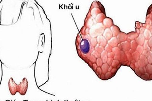 Ai có nguy cơ cao mắc ung thư tuyến giáp?