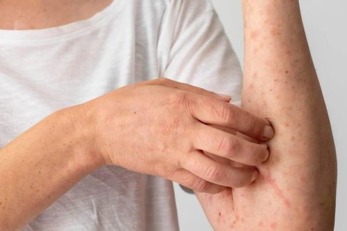 Nhiều bệnh da liễu phát triển trong mùa hè