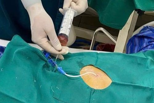Cứu sống cụ ông 71 tuổi bị tràn dịch màng ngoài tim do lao
