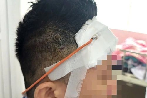2 tháng sau tai nạn mới bị máu tụ chèn ép não