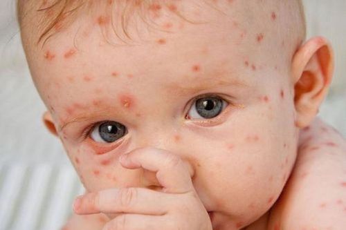 Sởi, căn bệnh truyền nhiễm nguy hiểm nhất thế giới đang quay trở lại