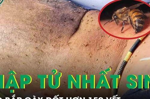 Ong đốt hơn 150 vết, người đàn ông thập tử nhất sinh