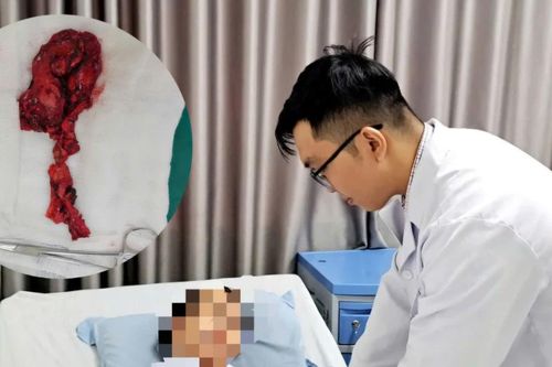 Nam thanh niên 27 tuổi ở TPHCM bị tuyến ức phì đại gây sụp mí mắt
