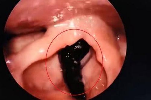 Cháu bé 3 tuổi bị đỉa chui vào đường hô hấp khi tắm suối