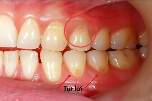 Tụt lợi điều trị được không và cách khắc phục