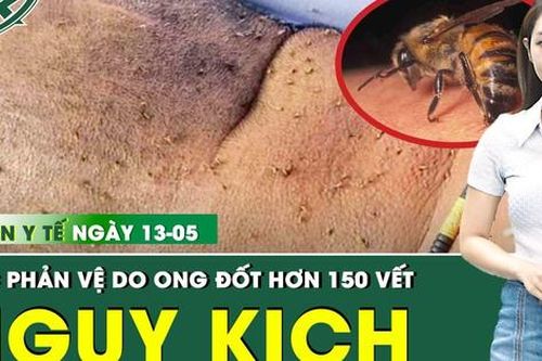 Bản tin Y tế 13/5: Bị ong đốt hơn 150 vết, người đàn ông sốc phản vệ, nguy kịch tính mạng