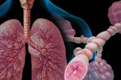 Khoảng 4 triệu người Việt mắc bệnh hen, gánh nặng bệnh tật không nhỏ