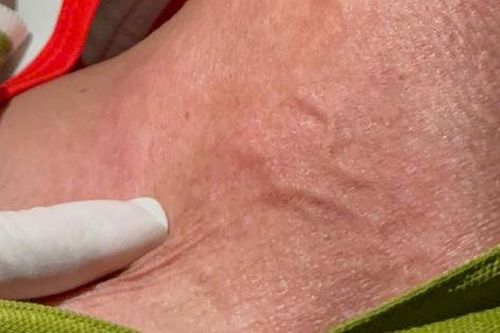 Việt Nam ghi nhận ca mắc giun rồng 26, bác sĩ chỉ cách phát hiện sớm