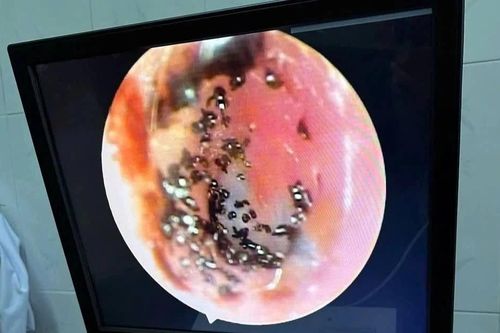 Hàng trăm con ve chó làm tổ trong tai bé trai 9 tuổi