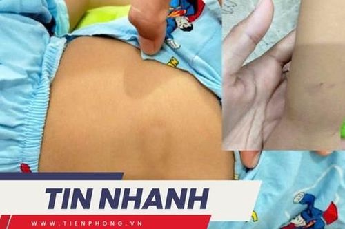 TIN NHANH: Đình chỉ cơ sở giữ trẻ sau vụ bé gái hơn 2 tuổi bị chấn thương 'vùng kín'