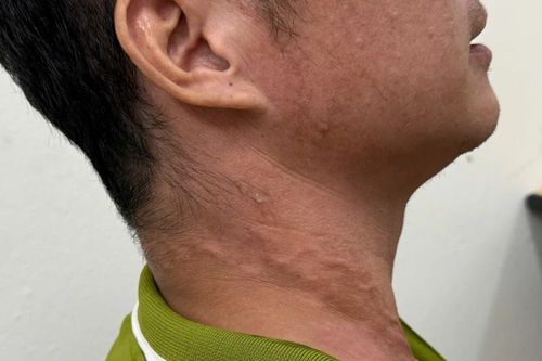 Ghi nhận bệnh nhân thứ 26 mắc giun rồng tại Việt Nam