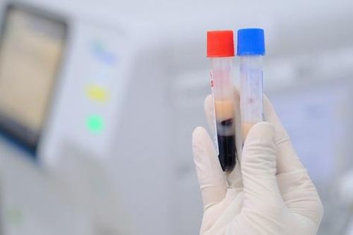 Cảnh giác với dấu hiệu dự báo nguy cơ đột quỵ bị bỏ sót ở người trẻ