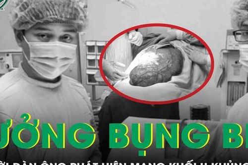 Tưởng bụng bia, người đàn ông tá hỏa phát hiện mang khối u nặng 8 kg