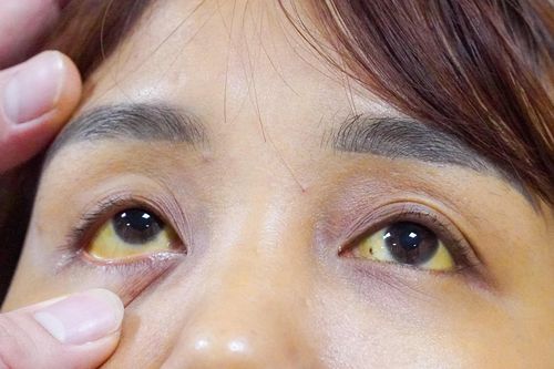 Gan bị hủy hoại vì nhiễm virus HBV