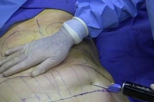 Bệnh nhân nhiễm trùng sau phẫu thuật hút mỡ tại TPHCM