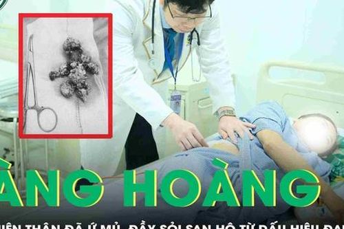 Đau lưng nhưng chủ quan, người phụ nữ không ngờ thận đã ứ mủ, đầy sỏi san hô