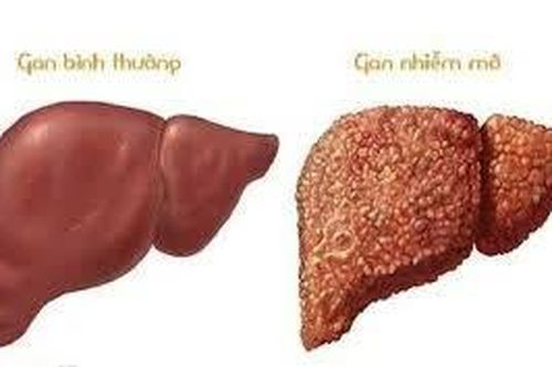 Giảm 12kg và hết bệnh gan nhiễm mỡ nhưng liệu có tái phát không?